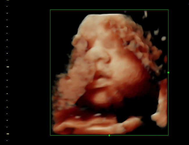 3D ultrasound image at 28 weeks